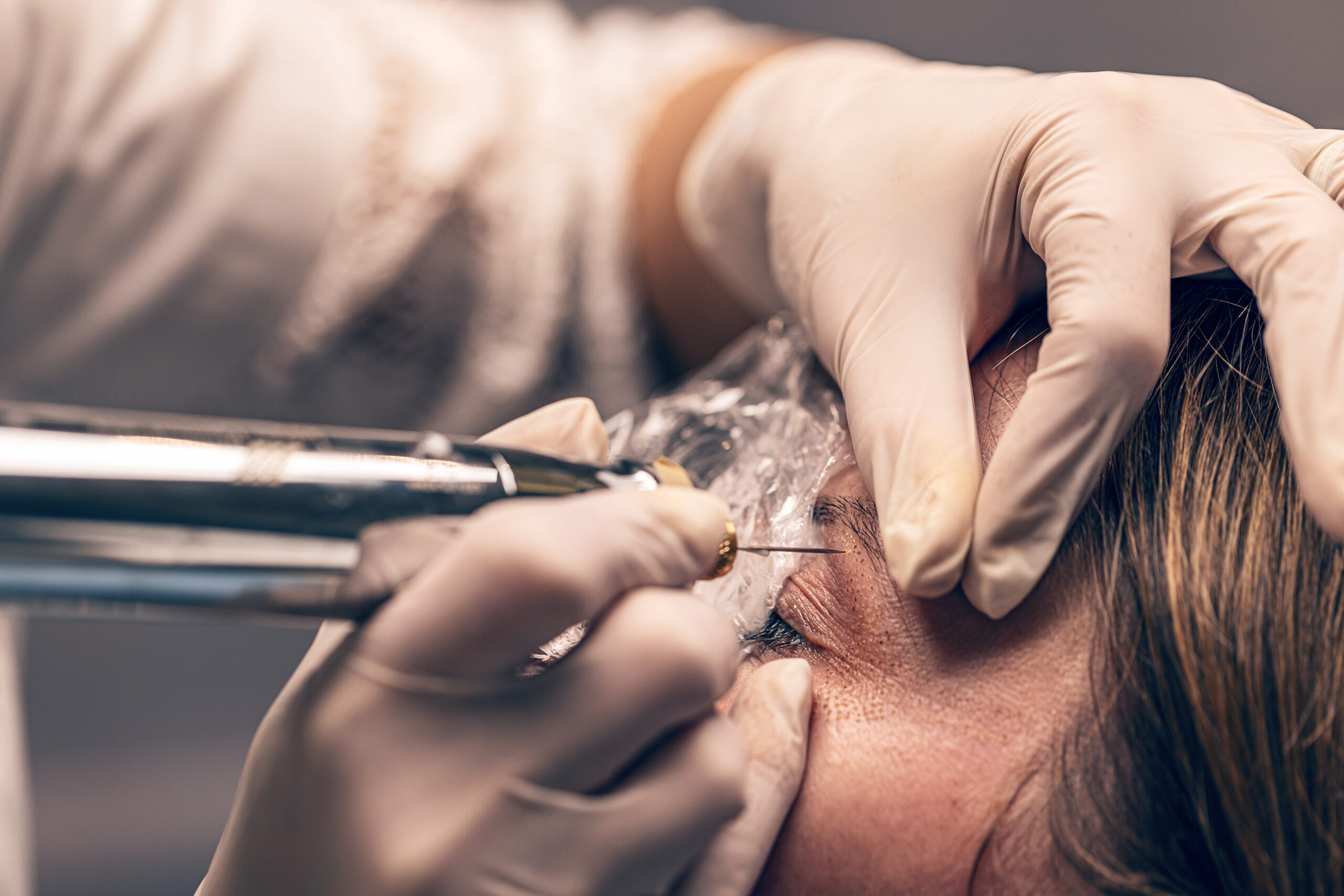 PlexR-Plasmalifting zur Hautstraffung und Muttermalentfernung